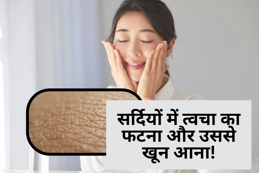 सर्दियों में त्वचा का फटना और उससे खून आना!
