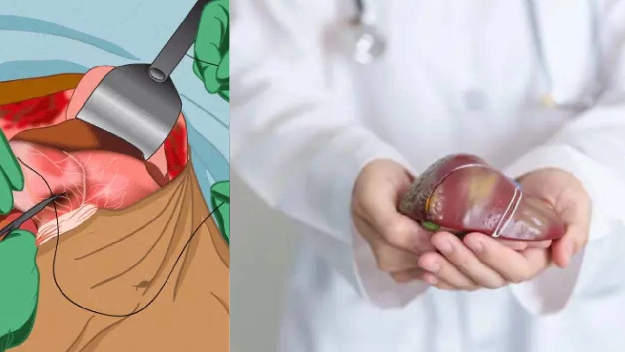 क्या लिवर ट्रांसप्लांट सच में बचा सकता हैं जिंदगी_एक नज़र!